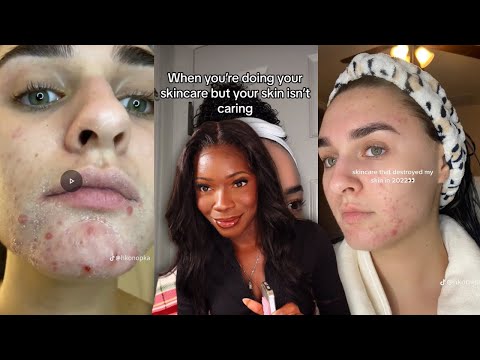 tiktok trends r DAMAGING your sensitive skin 💔