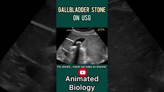 Gall balder stone in USG | How Gall balder stone looks like in USG ?