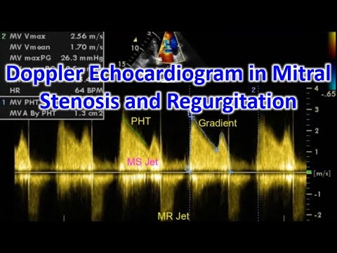 Doppler Echocardiogram in Mitral Stenosis and Regurgitation