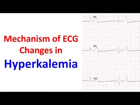 Mechanism of ECG changes in hyperkalemia