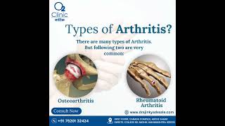 Arthritis Unveiled: Your Guide to Joint Health! #Orthopedic