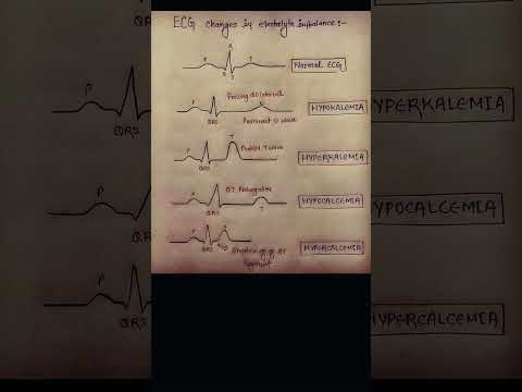 ECG changes in electrolyte imbalance