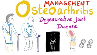 Osteoarthritis (OA) - Treatment -  Degenerative Joint Disease - Rheumatology Series