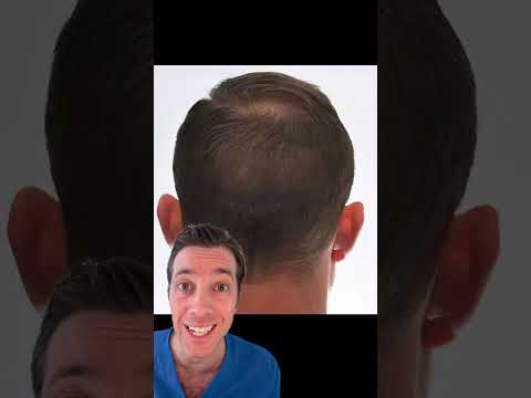 FUE vs. FUT Hair Transplant: What’s the Difference?