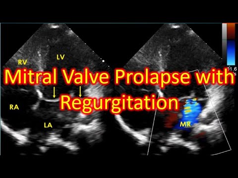 Mitral Valve Prolapse with Regurgitation