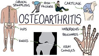 Understanding Osteoarthritis