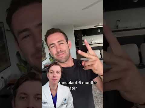 Unbelievable 6-Month Hair Transplant