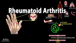 Rheumatoid Arthritis, Animation