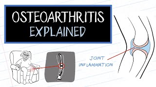 What is Osteoarthritis? (HealthSketch)