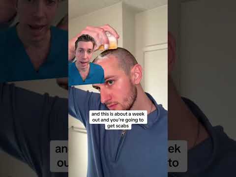 Post-Washing Your Scalp After a Hair Transplant