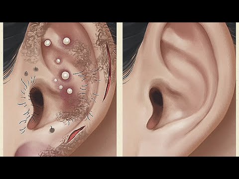 Ear Wax ASMR |  Cleaning Cleaning & asmr  ear treatment #Earcleaning