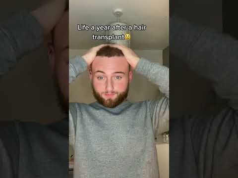 Hair Transplant Recovery After 1 Year