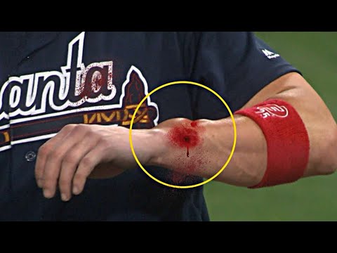 MLB•| Worst And Brutal Hit By Pitch