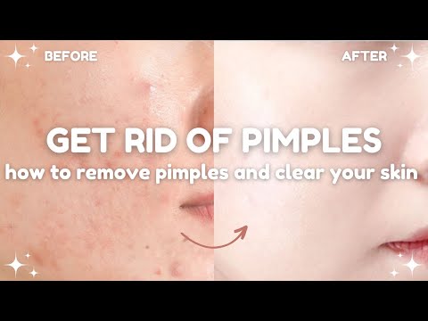 how to get rid of pimples and clear your skin 🧴🫧 acne treatments and do's and don'ts