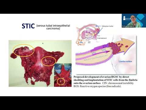 New approaches to ovarian cancer treatment - Prof Christina Fotopoulou (Part 2 of 2)