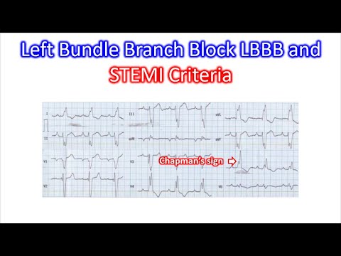 Left Bundle Branch Block LBBB and STEMI Criteria