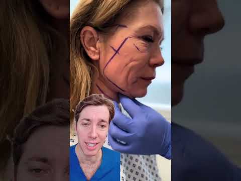 Transformation with a Deep Plane Facelift