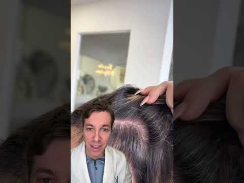 Considering an FUE Hair Transplant as a Female Patient?