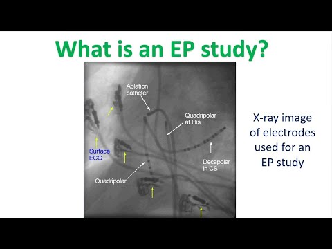 What is an EP study?