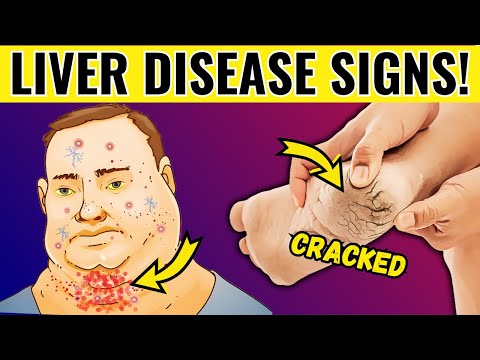 Your Liver Is SLOWLY DYING. 10 Signs Liver Damage Cirrhosis!