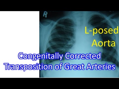 Congenitally Corrected Transposition of Great Arteries