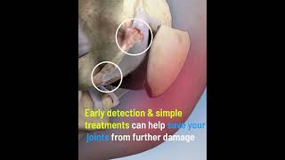 World Osteoarthritis Day | Joint Health | Joint preservation | TriCell Biologics |