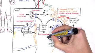 Rheumatoid Arthritis Pathophysiology (signs and symptoms)