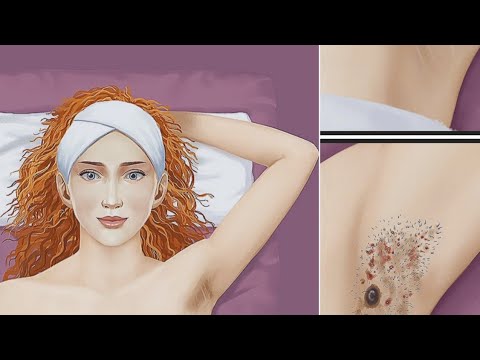 ASMR Armpit Hair Removal || Armpit Waxing