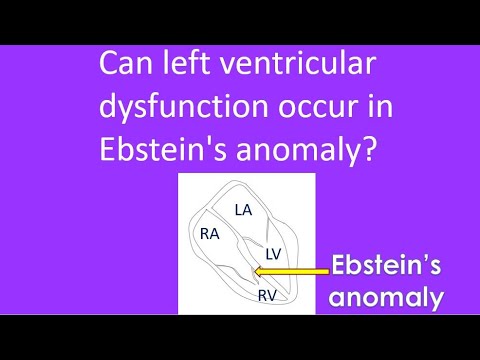 Can left ventricular dysfunction occur in Ebstein's anomaly?