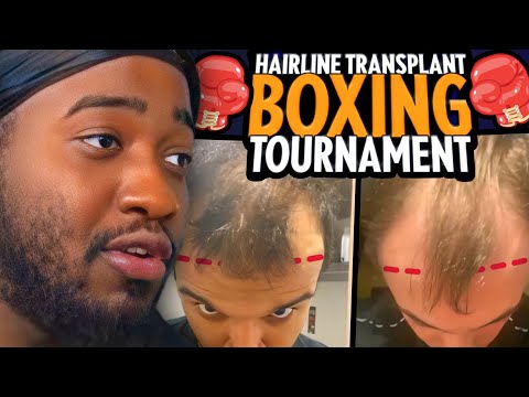 I'm Hosting A Hairline Transplant Boxing Tournament🥊🔥