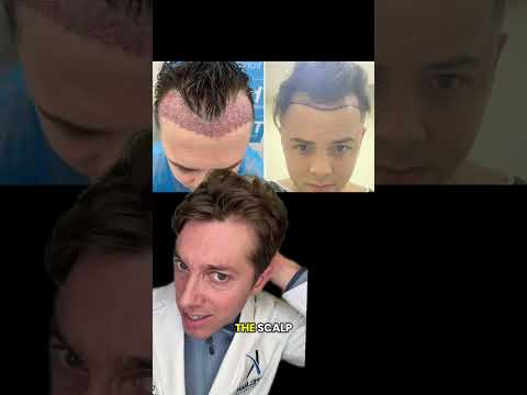 Too Young for a Hair Transplant? Understand This Before You Decide!