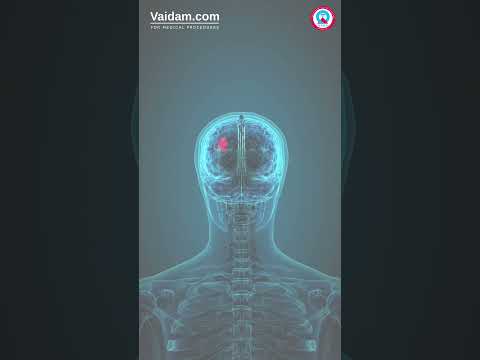 Symptoms of Brain Tumor #trending #shorts #viralvideo #health #braintumor