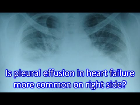 Is pleural effusion in heart failure more common on right side?